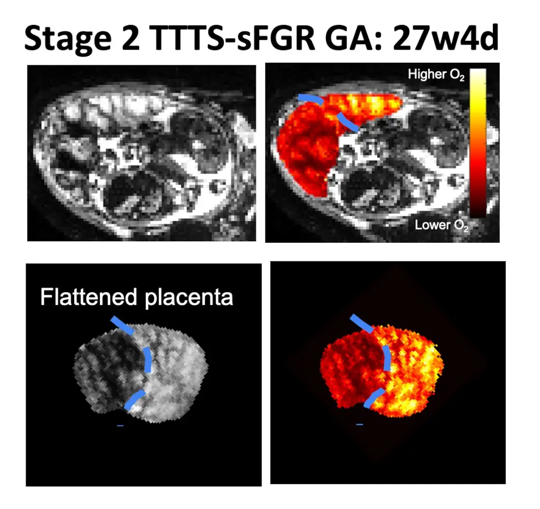 MRI image showing a placenta, placental measurements, a flattened placenta and a placenta diagnosed with Stage 2 TTTS and sFGR (GA at MRI: 27w4d).