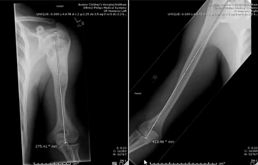 At left: A look at a young man’s arm that had stopped growing. At right: The arm after two years of limb-lengthening treatment.