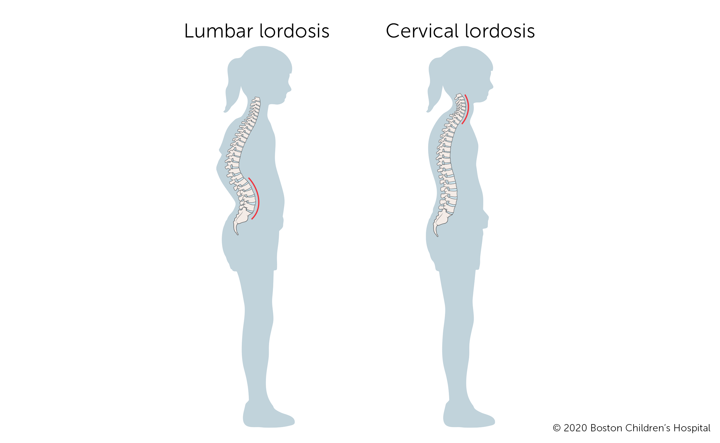 Illustration: How lumbar lordosis looks compared to cervical lordosis.