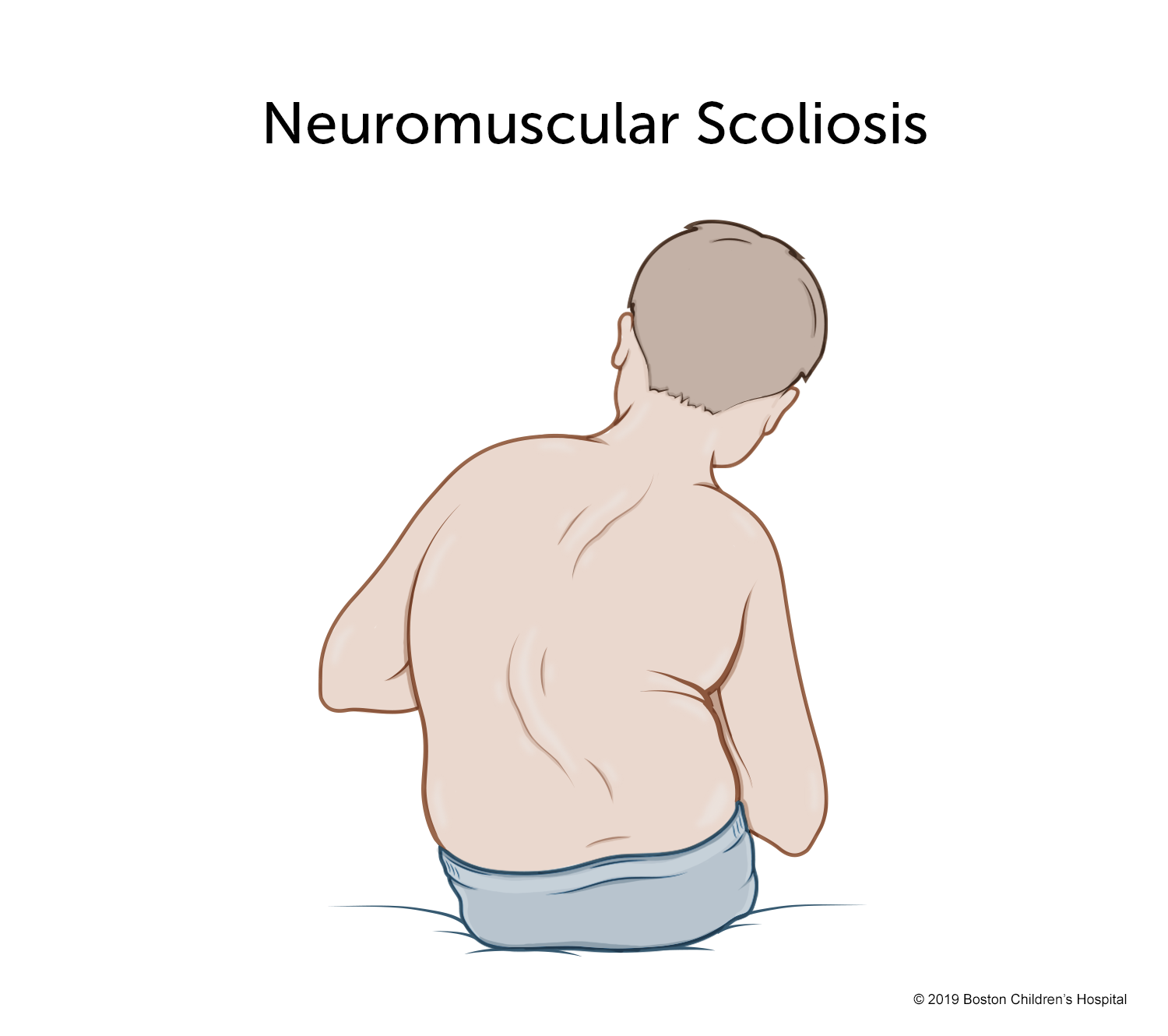 Diagram showing the back of a seated child with a visible sideways curvature of the spine, labeled “Neuromuscular Scoliosis.”