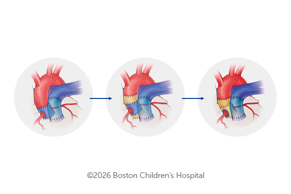 A depiction of a Ross procedure: A pulmonary valve is placed in the aortic root and prosthetic material is added for support.