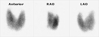 Three thyroid scan images labeled Anterior, RAO, and LAO showing different views of the thyroid gland with varying distribution of radiotracer uptake.