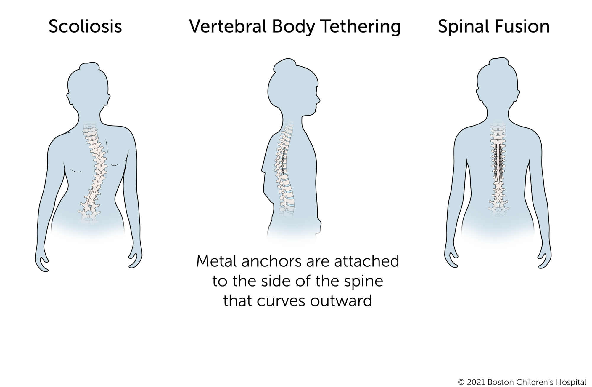 Educational diagram comparing scoliosis and two surgical treatments.