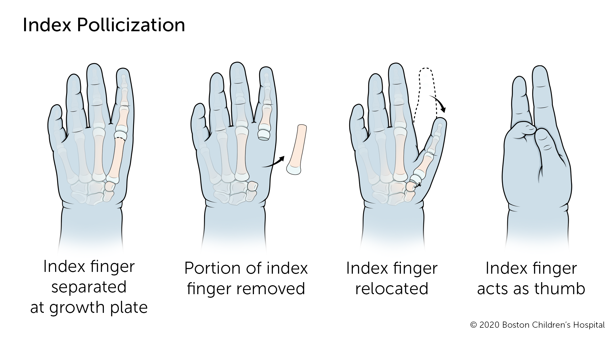 If the thumb is completely missing, index pollicization surgery moves the index finger into the thumb position. The index finger is separated at the growth plate, a section of the finger is removed from the hand, and the remaining finger is relocated to w