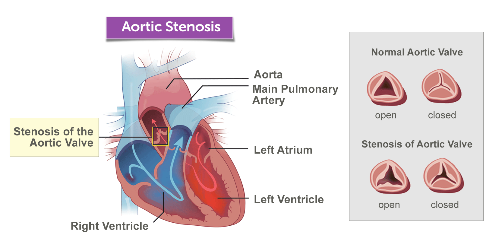A view of the heart valve when normal and when affected by aortic stenosis.