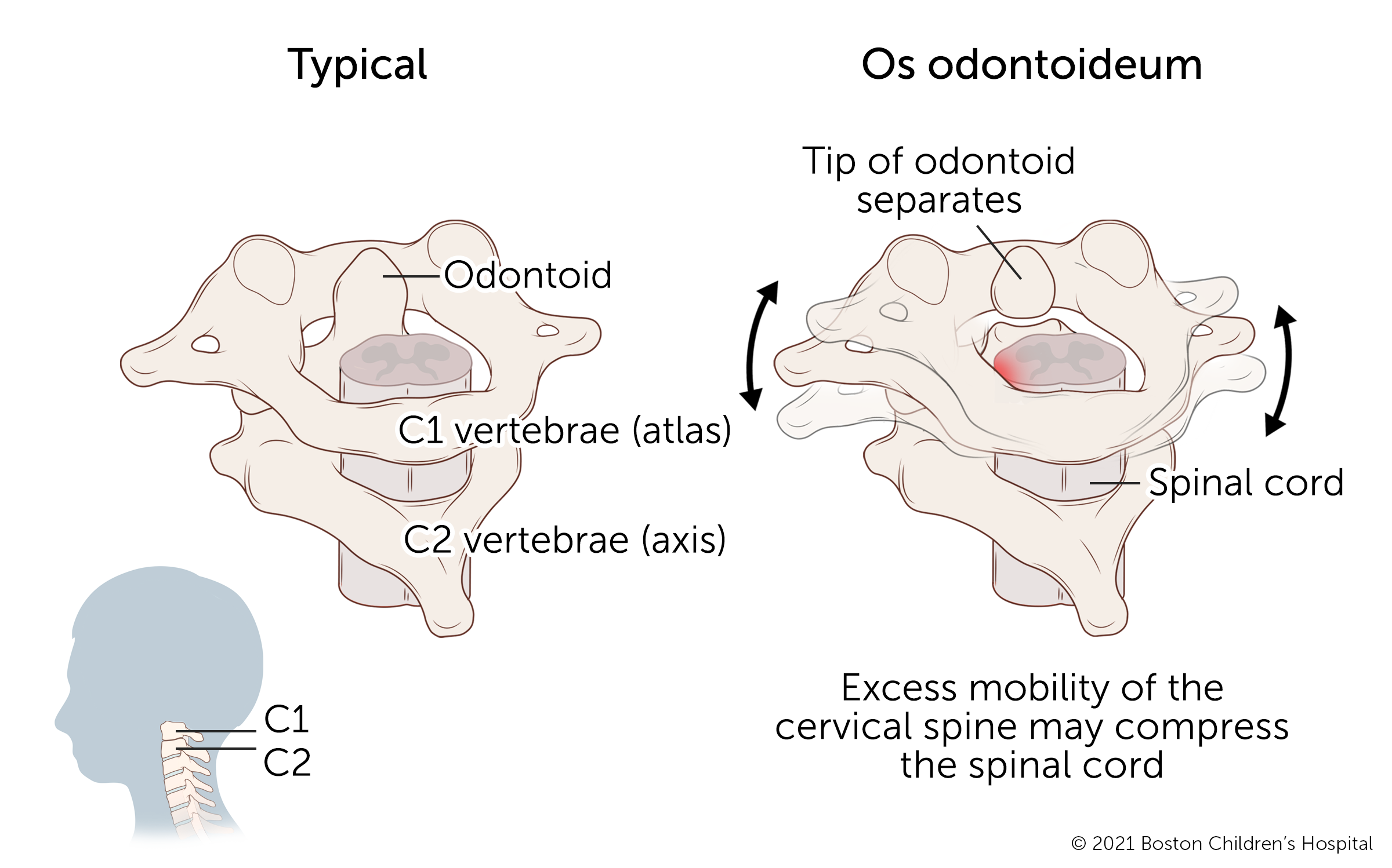 The cervical spine is made up of bones called vertebrae. Os odontoideum occurs when the tip of the second cervical vertebra separates from the rest of the bone.