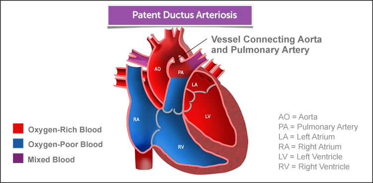 Patent ductus arteriosis involves the vessel connecting the aorta and the pulmonary artery.
