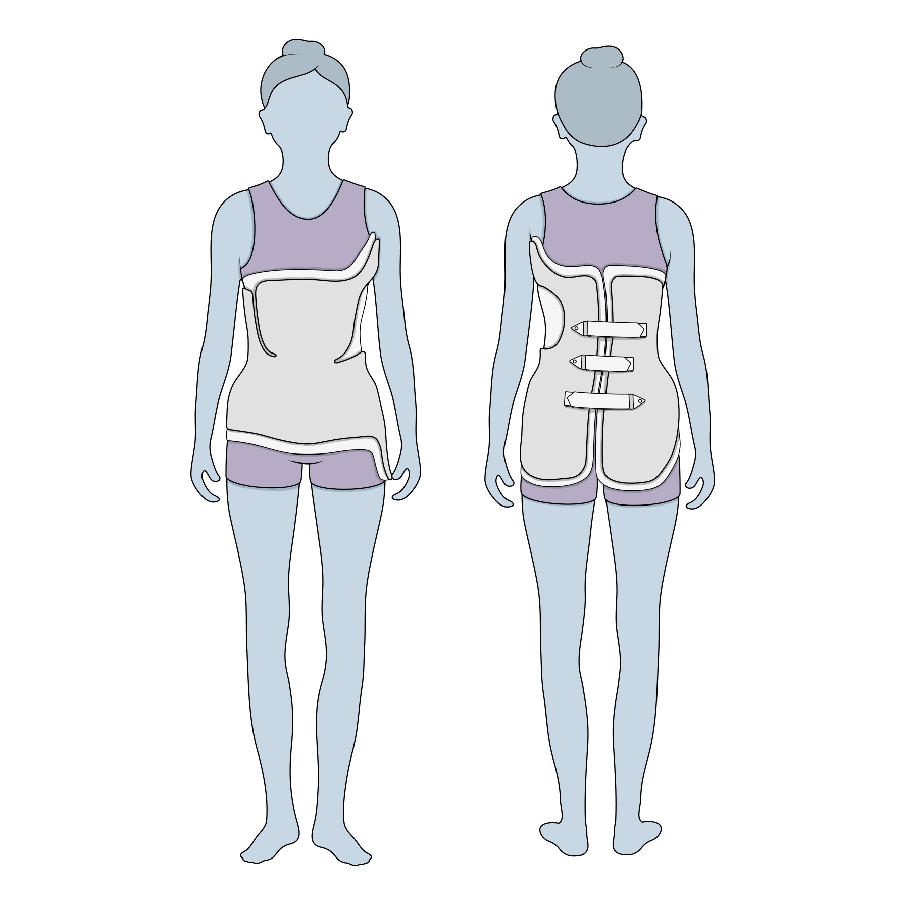 Illustration of scoliosis bracing treatment.