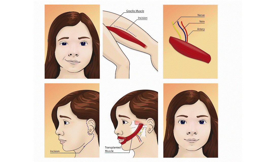 Facial reanimation illustration