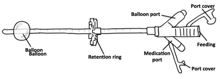 Illustration of G-tube with labels
