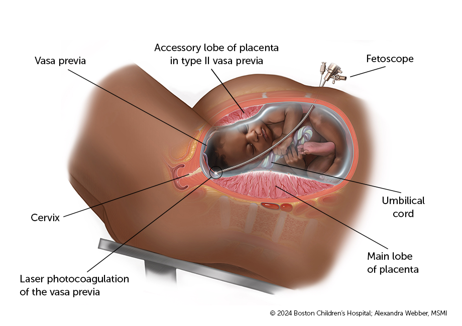 Medical illustration of fetoscopic laser photocoagulation for vasa previa