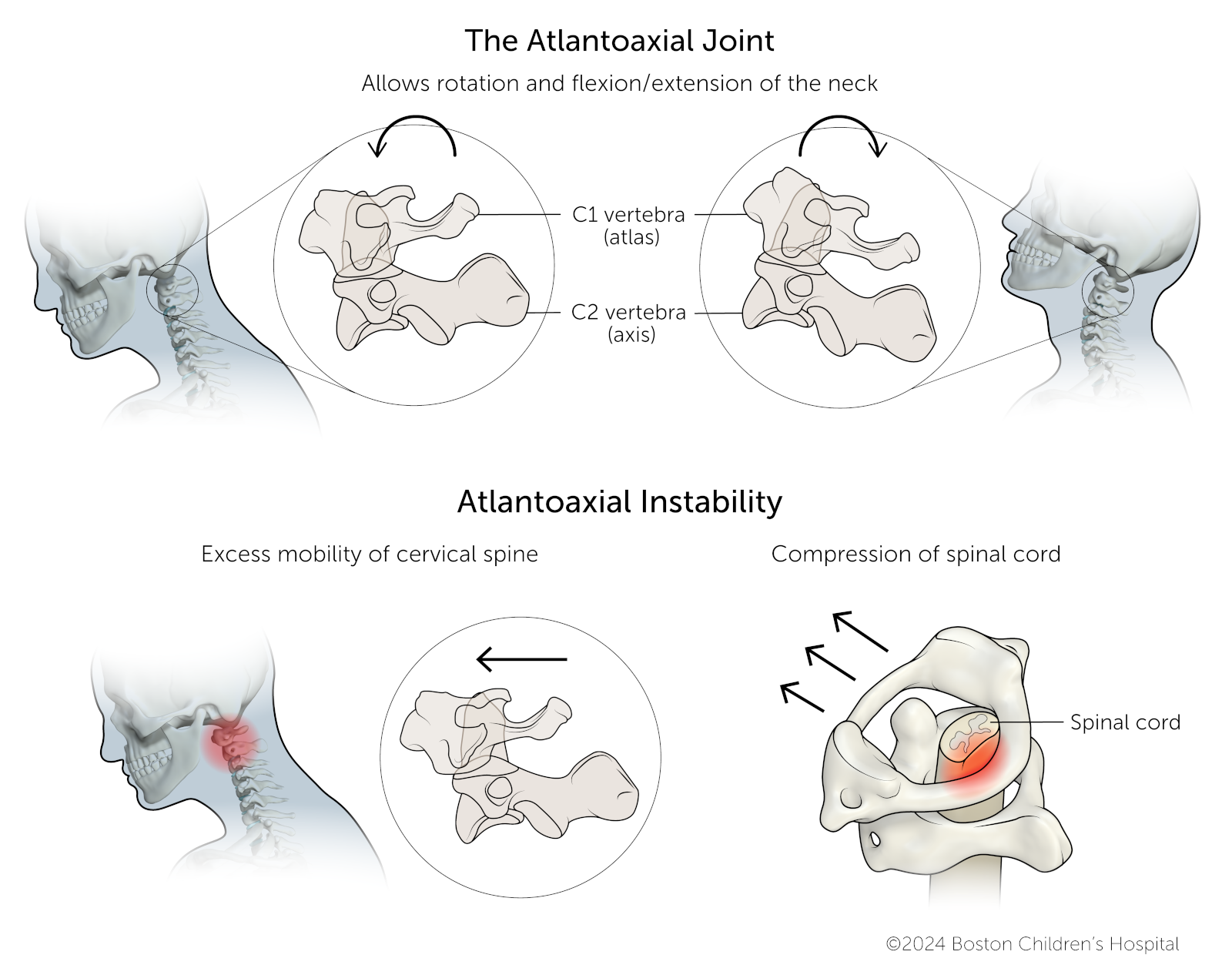 The atlantoaxial joint allows the neck to rotate and extend. When this joint is too mobile, the vertebrae compress the spinal cord.