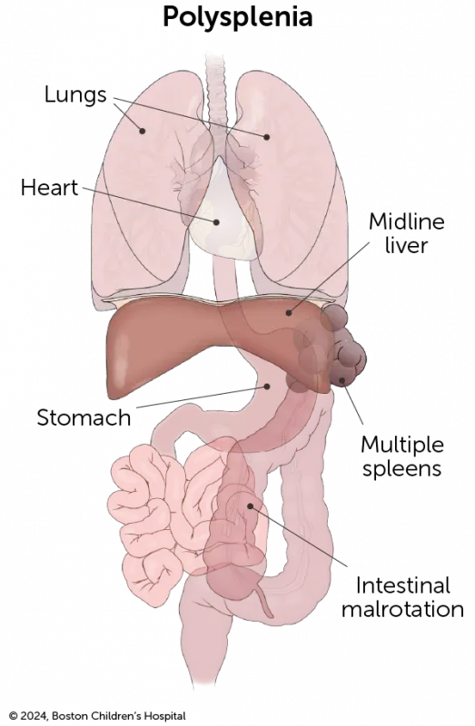 An illustration of heterotaxy with polysplenia shows multiple spleens.