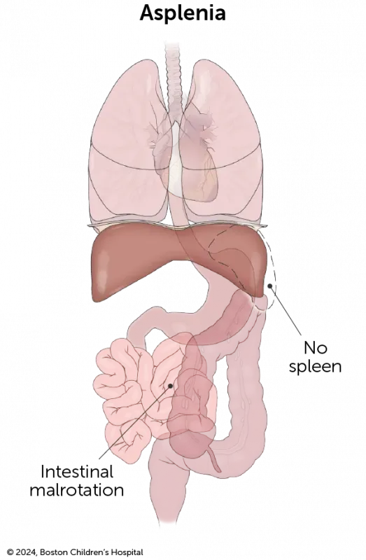 An illustration of heterotaxy with asplenia shows there is no spleen.
