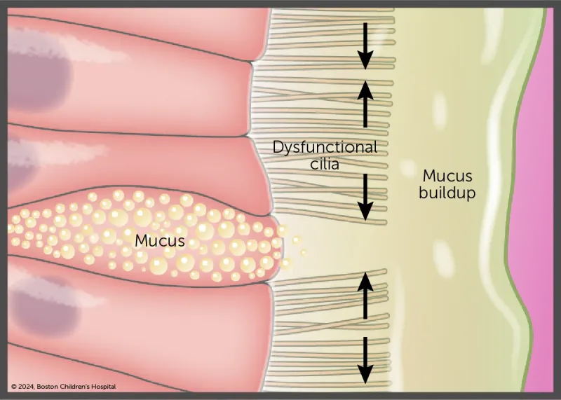 An illustration show the mucus buildup of dysfunctional ciliary, a condition that exists in some people who have heterotaxy.