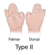 illustration of hands with fingers and thumbs fused together
