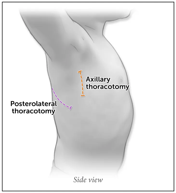 A medical illustration of the incision spots for posterolateral and axillary thoracotomy approaches to treating heart defects.