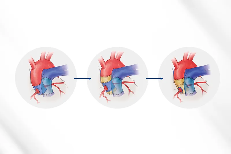 A depiction of a Ross procedure: a pulmonary valve is placed in the aortic root and prosthetic material is added for support.