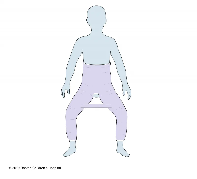 Illustration of a person wearing a spica cast, which covers the torso, hips, and legs, leaving an opening at the crotch. The cast extends from the chest to the ankles with a bar between the legs.