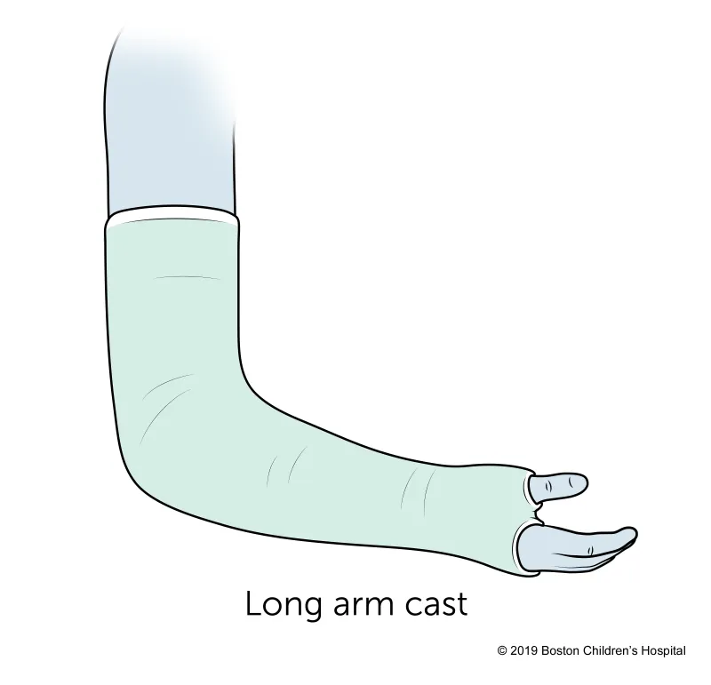 Illustration of a long arm cast covering the arm from the upper arm to the hand, leaving the thumb and fingers exposed. The text below reads: Long arm cast.
