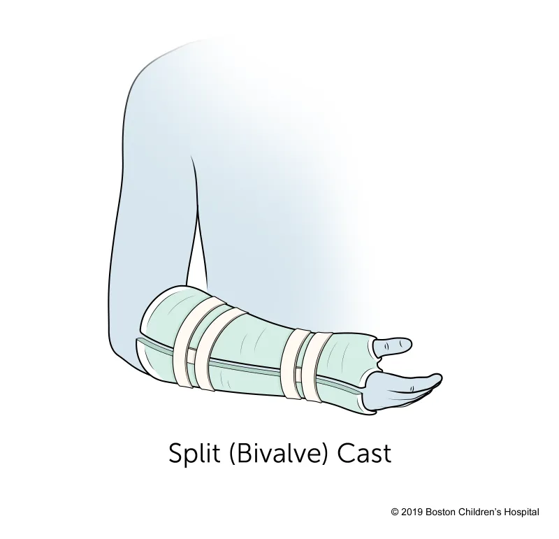 Medical illustration of a forearm in a split (bivalve) cast, secured with three straps, with the palm facing upward.