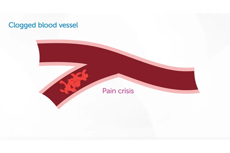 Diagram labeled "Clogged blood vessel" and "Pain crisis" showing red blood cells blocking blood flow in a Y-shaped blood vessel.