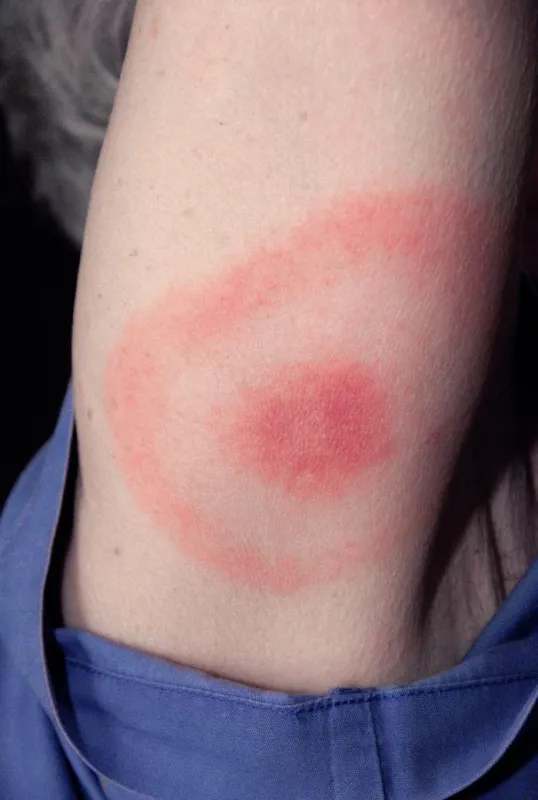 An image of a large tick bite, which is similar in appearance to a bull's eye, on an arm