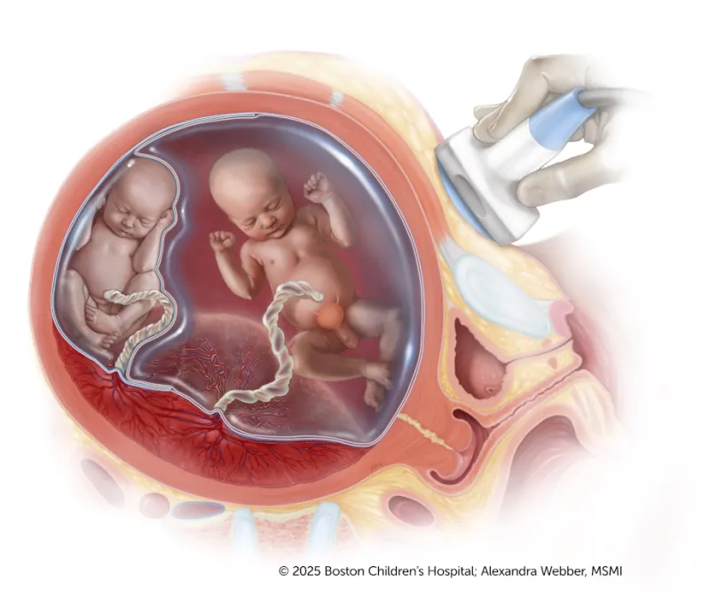 A medical illustration of an ultrasound scan of twins sharing a placenta, with no visible bladder in the donor twin and uneven amniotic fluid.