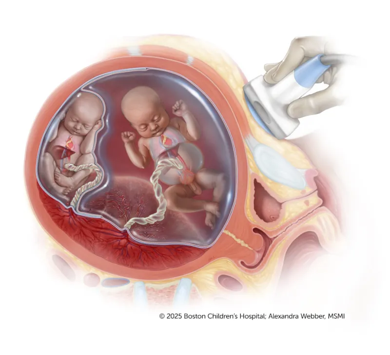 Medical illustration of a cross-section of a uterus with twins, each in their own amniotic sac. A hand holds an ultrasound device above the womb.