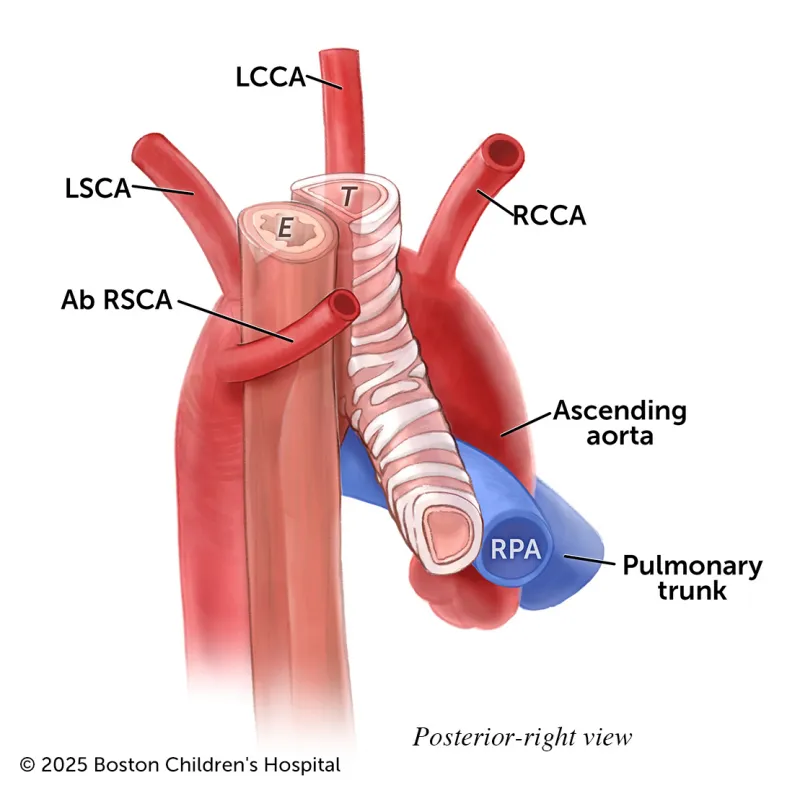 A medical illustration highlights key features of a left aortic arch with aberrant right subclavian artery.